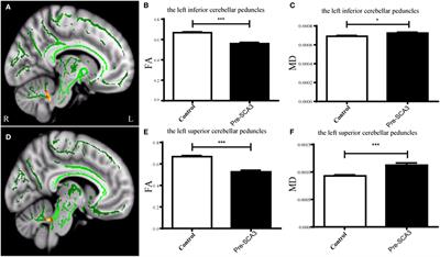 Microstructural Alterations in Asymptomatic and Symptomatic Patients with Spinocerebellar Ataxia Type 3: A Tract-Based Spatial Statistics Study
